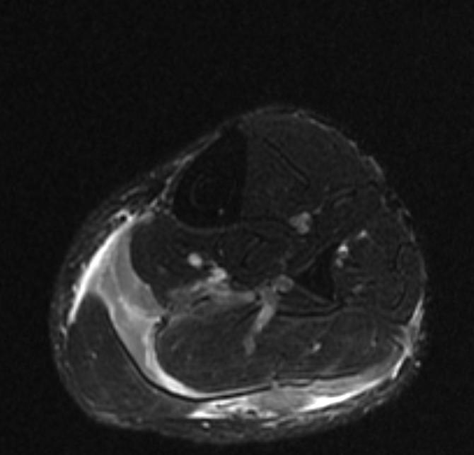 File:Plantaris rupture MRI 006.jpg