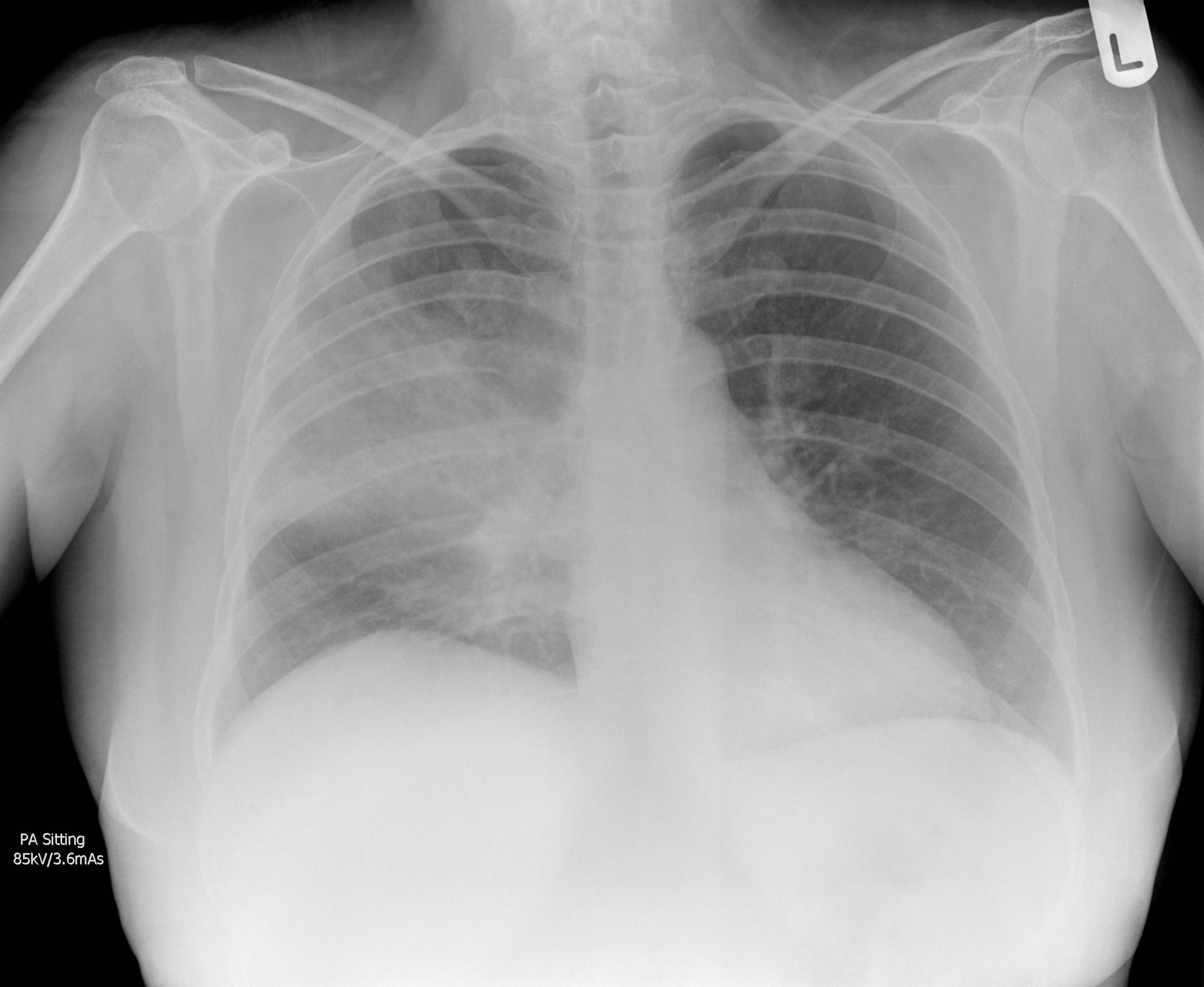 File:Pneumococcal-pneumonia (right upper lobe).jpg