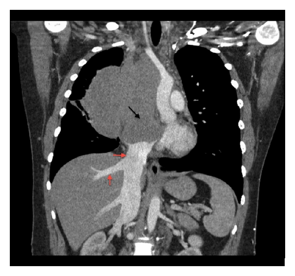 Coronal CT scan image elucidates a mediastinal mass with extension into the right atrium (black arrow) with complete encasement and compression of the SVC. The tumor extends to the confluence of the IVC in the right atrium causing dilatation of the intraabdominal IVC and hepatic veins suggesting compromised cardiac return (red arrows). Tumor causes the displacement of great vessels into the left hemithorax.[5]