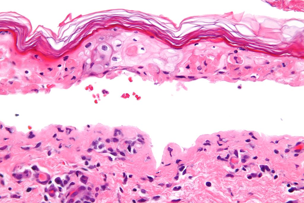 Confluent epidermal necrosis(very high mag)[6]