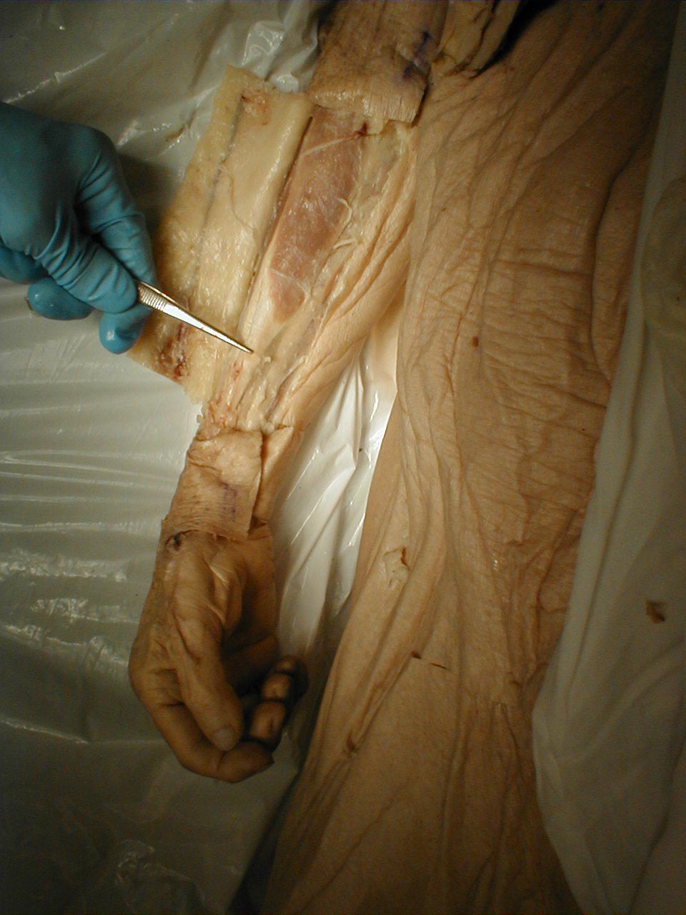 Brachioradialis tendon: The tendon is grasped by forceps (gross dissection)