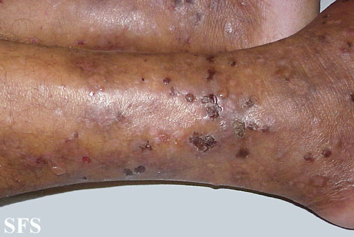 File:Dermatitis herpetiformis12.jpg