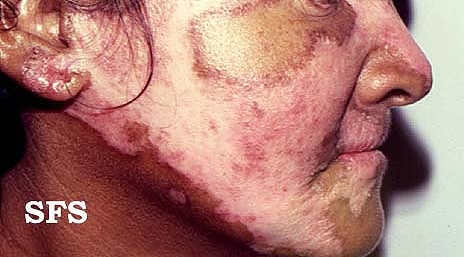 Discoid lupus erythematosus. Adapted from Dermatology Atlas.[15]