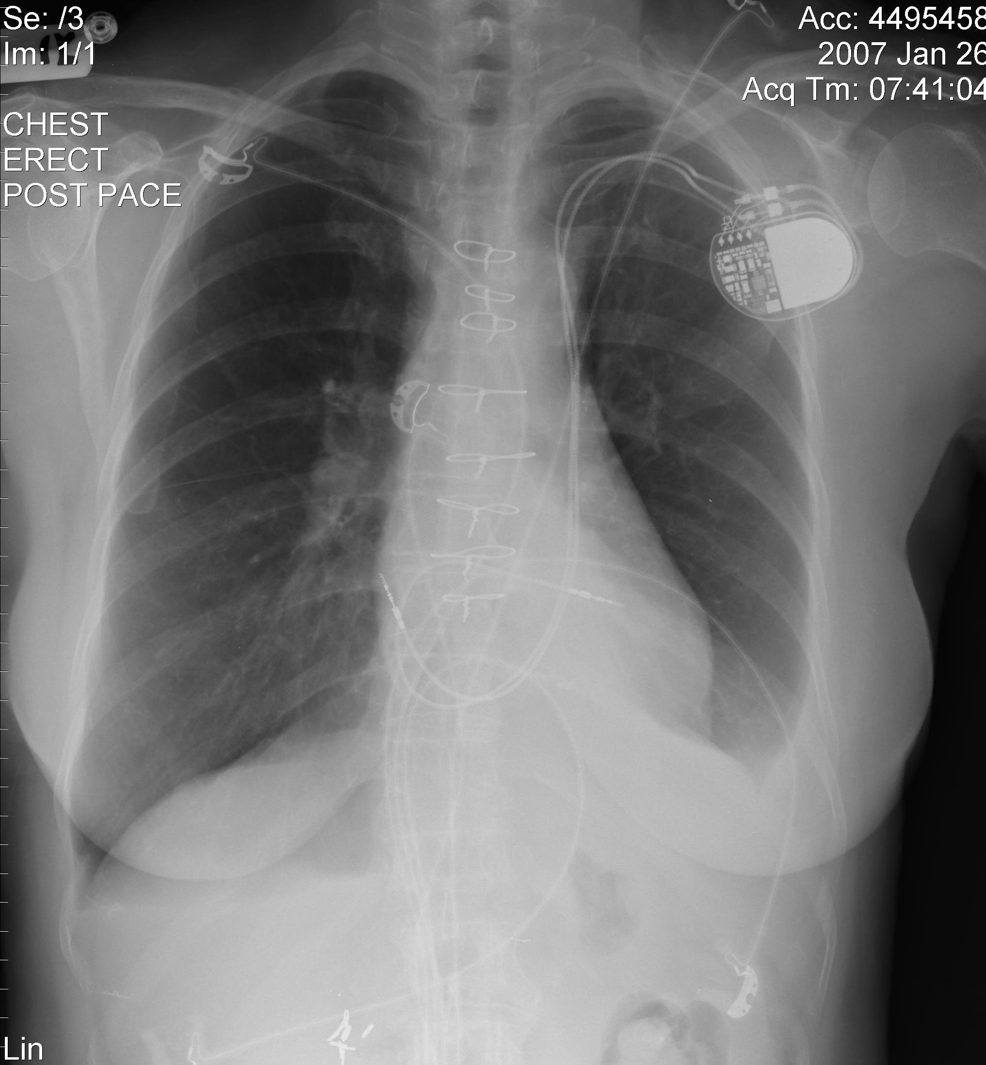 The atrial and ventricular pacemaker leads passing through a persistent left SVC.