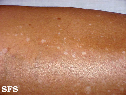 Idiopathic guttate hypomelanosis. Adapted from Dermatology Atlas.[1]