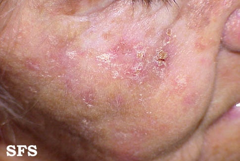 Actinic keratosisAdapted from Dermatology Atlas.[1]