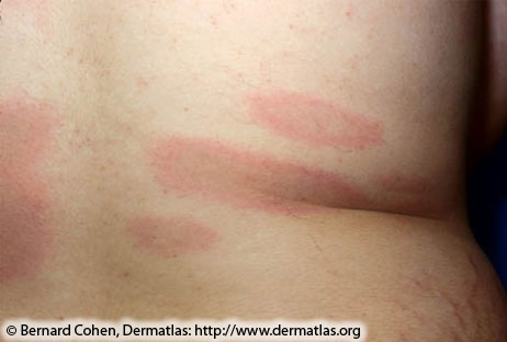 File:LymeMultiple rash, disseminated infection.jpg