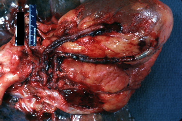 Saphenous vein coronary bypass graft: Gross, natural color, external view of heart with thrombosed veins